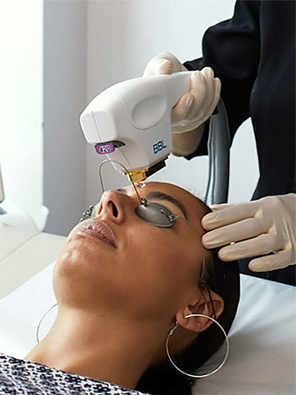 close up of a woman's face receiving the Forever Clear BBL treatment