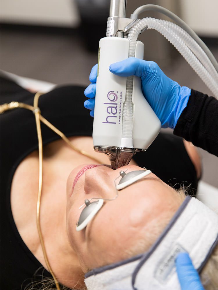 Close-up of the face of a woman who receives a laser treatment