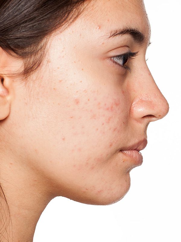 Close up of a woman's face closer to acne