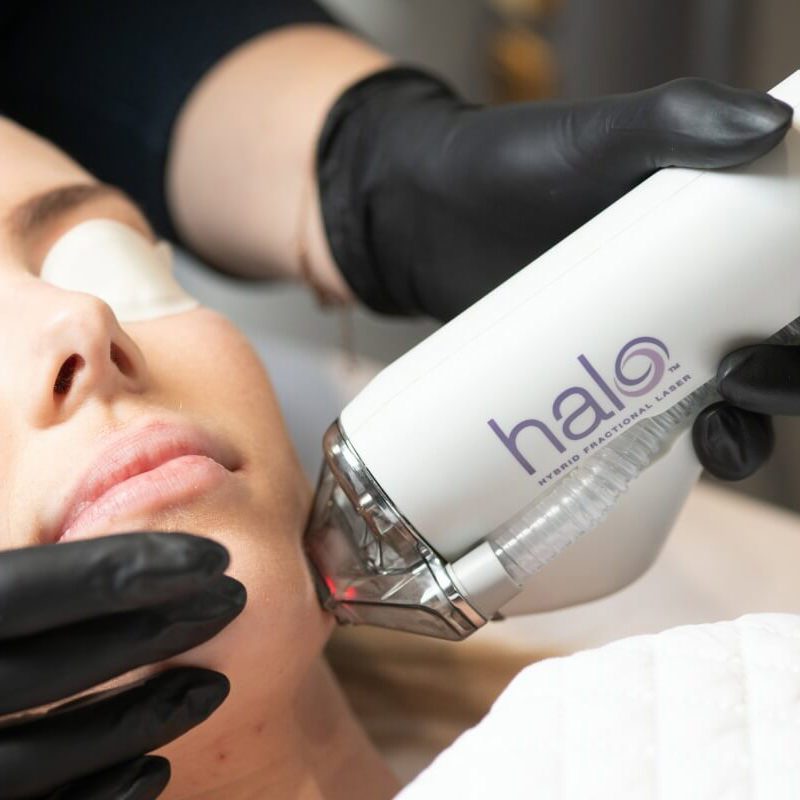 HALO Laser skin resurfacing