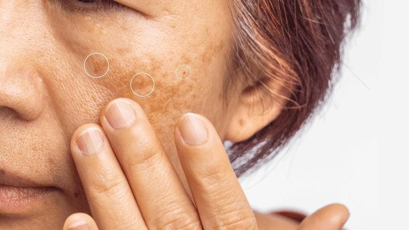 Damages skin without sunscreen